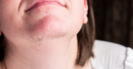 PCOS Facial Hair: Why it Happens and How to Deal With It